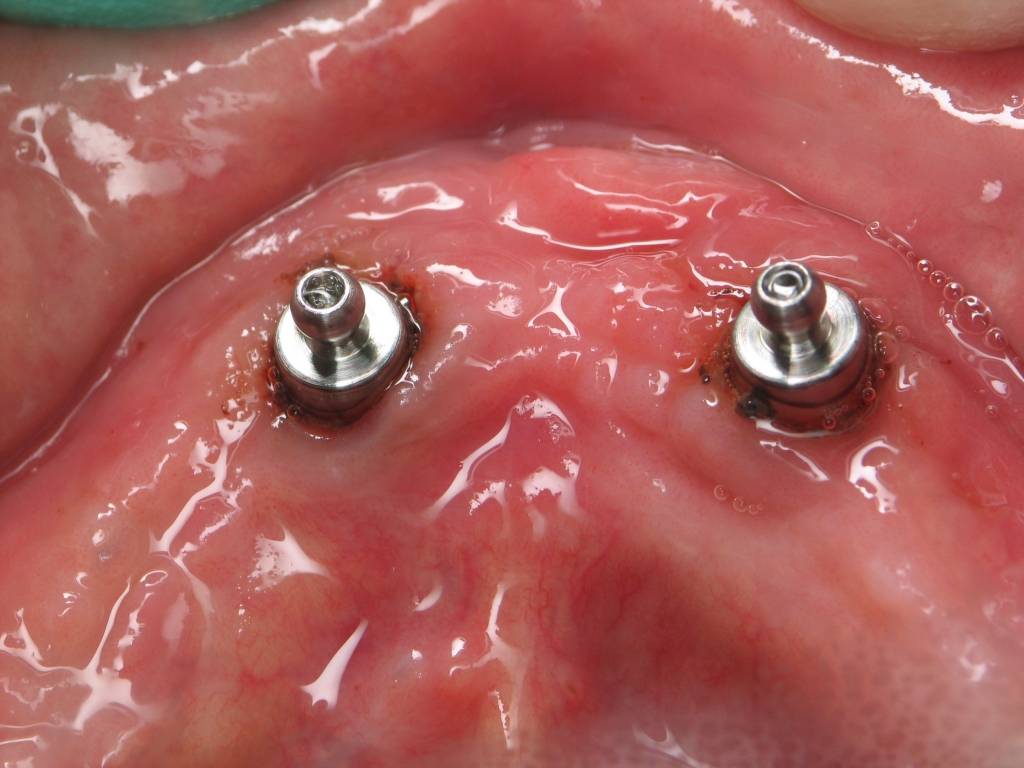 Implant Overdenture