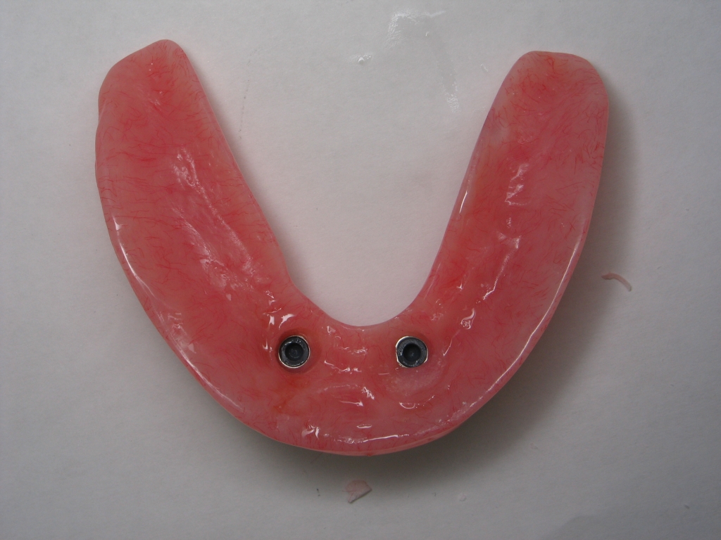 Overdenture