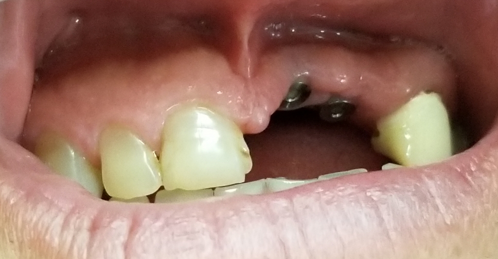 Pre-op Implants with Loss of Bone