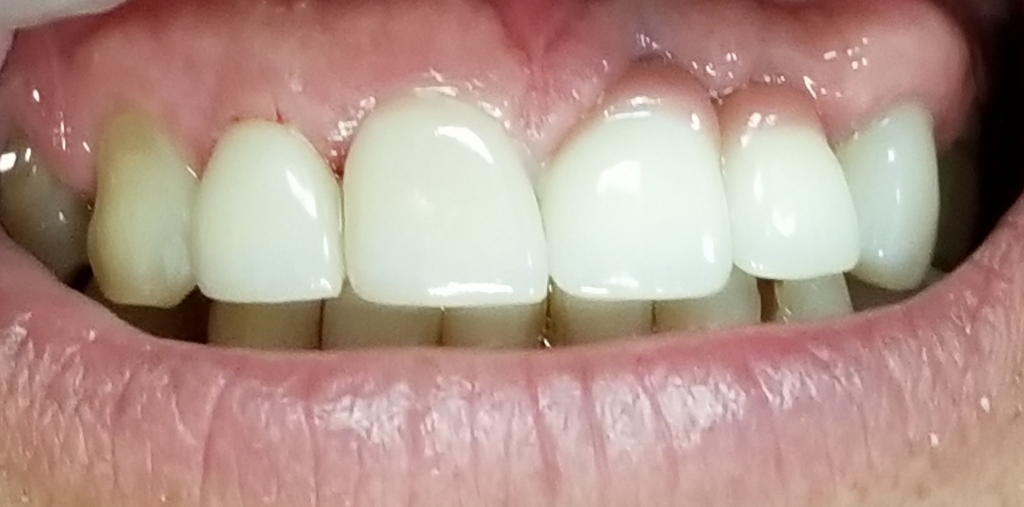 Post-op Implant Crowns with Fake Gums and Veneers